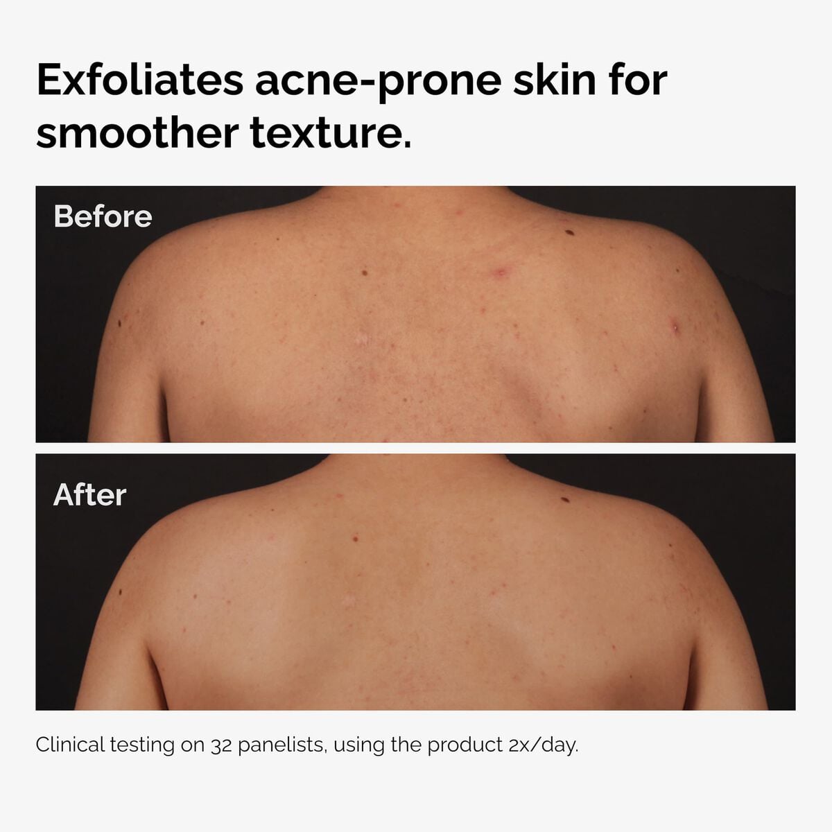 salicylic-acid-0-5-body-serum-v8 ord-salicylic-acid-body-serum-before-after-graphic-NA.jpg