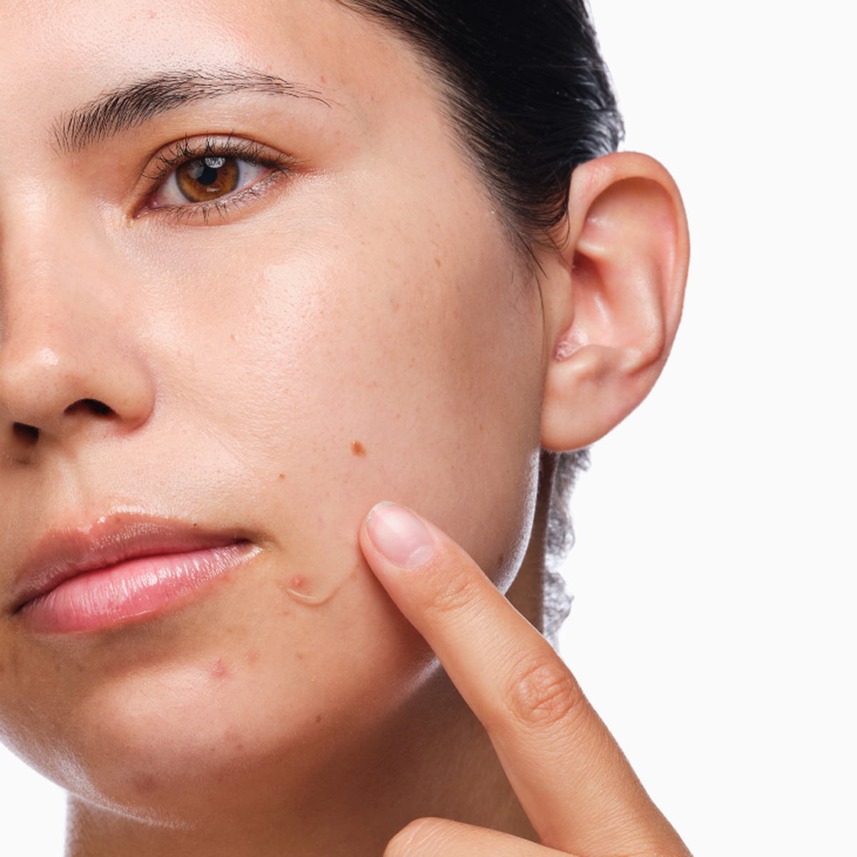 the-acne-set-f3 rdn-the-acne-set-application.png